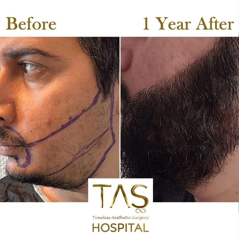 beard-transplant-before-and-after-turkey-28