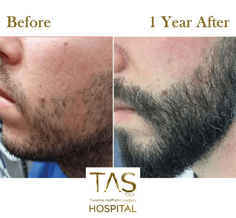 beard-transplant-before-and-after-turkey-69