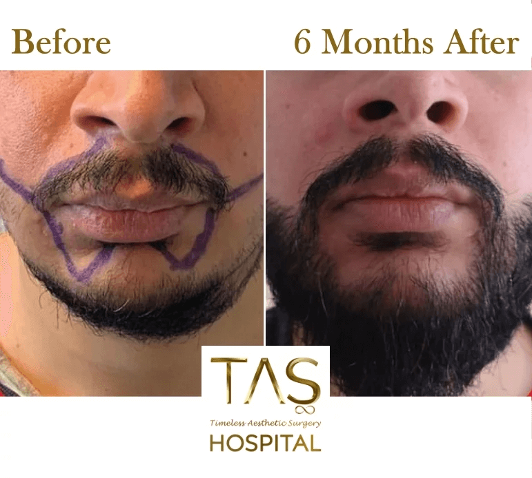 beard-transplant-before-and-after-turkey-78