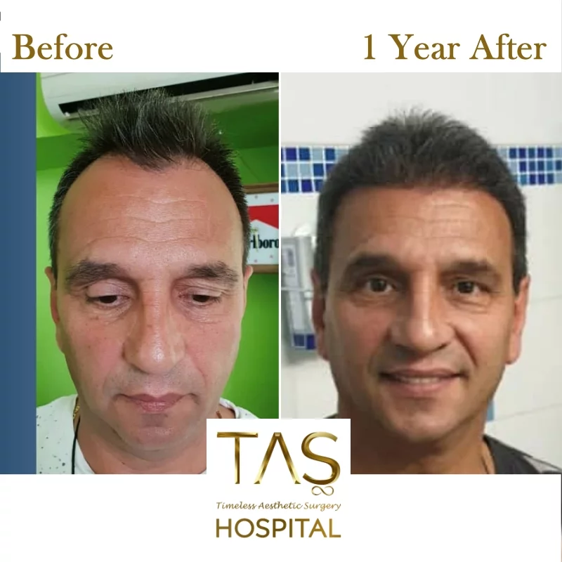 hair-transplant-before-and-after-turkey-