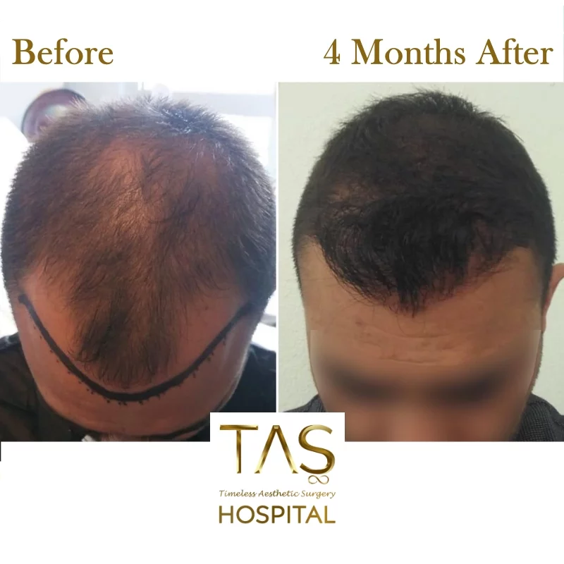 hair-transplant-before-and-after-turkey-141
