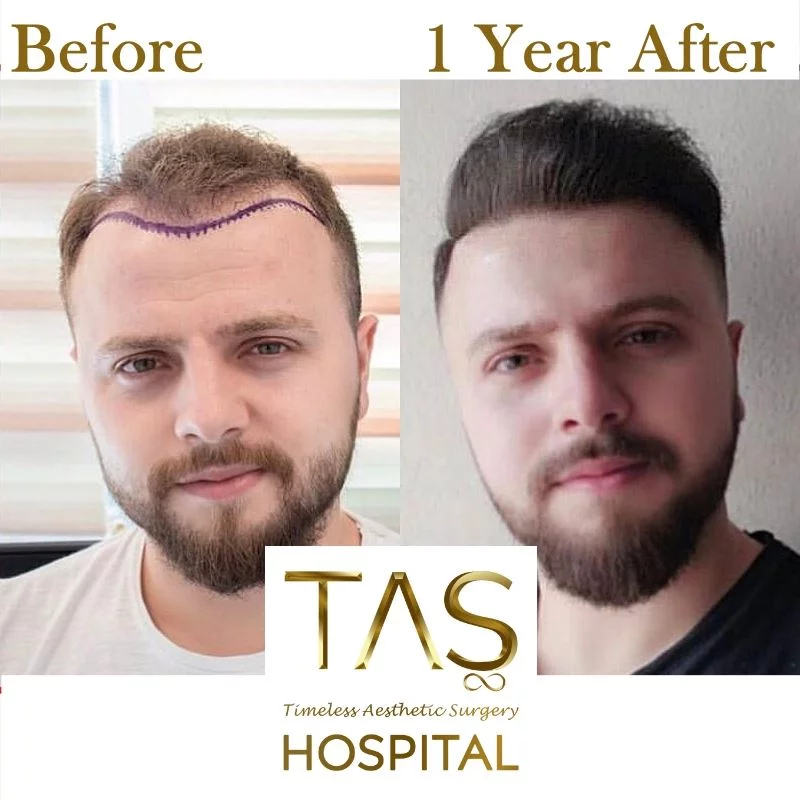 Hair Transplant in Turkey Procedure
