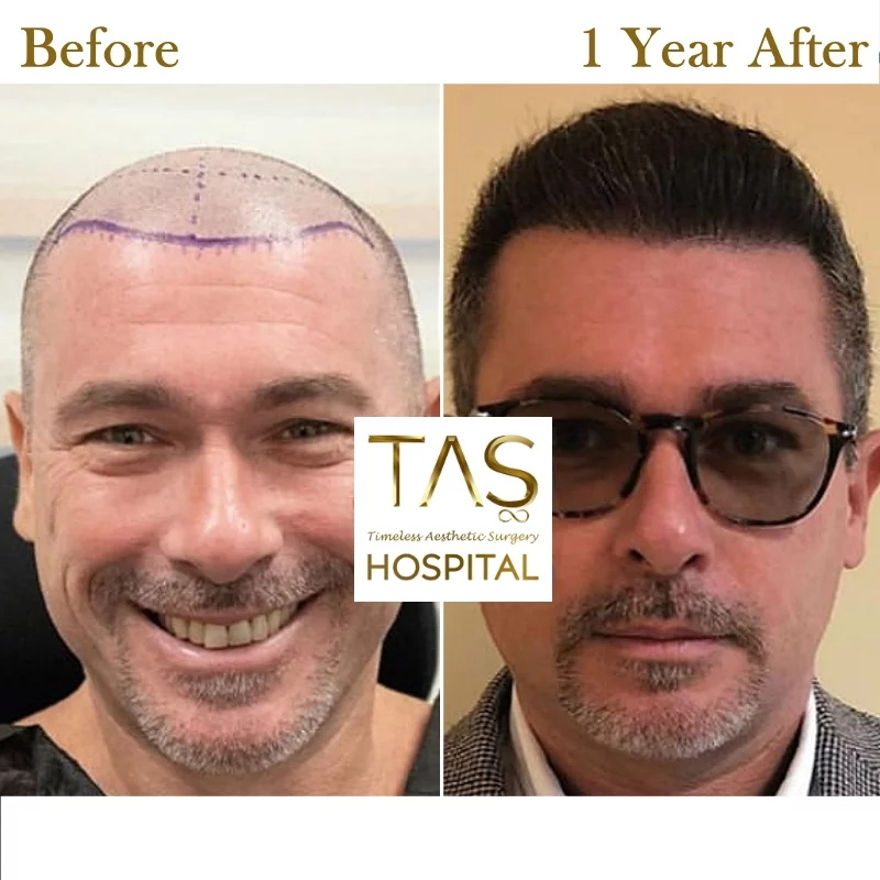 Hair Transplant Before and After Turkey