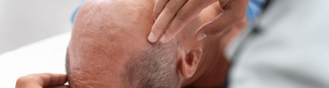 hair transplant in spring